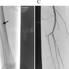 Abb 2 Dilatierende Arteriopathie Links Proximaler Und Mittlerer Download Scientific Diagram