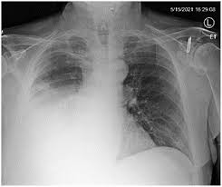 Image result for Lung Abscess