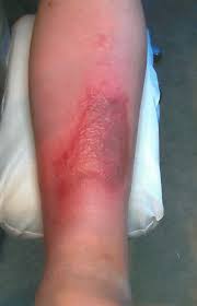 Image result for erysipel photos)