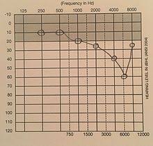 noise induced hearing loss wikipedia