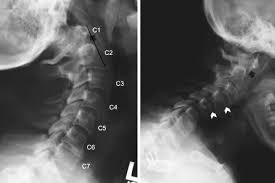 Les 5 dernières vertèbres cervicales « type » (c3 à c7) ont: Anomalias De La Union Craneocervical Trastornos Neurologicos Manual Msd Version Para Profesionales