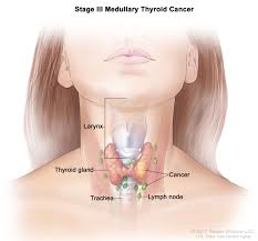 In stage ii, cancer has spread to bone around the maxillary sinus, including the roof of the mouth and the nose, but not to bone at the back of the maxillary sinus or the part of the sphenoid bone behind the upper jaw. Head And Neck Cancers Treatment Unm Cancer Center