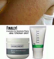 Could these red bumps on my forehead be keratosis pilaris? Pin On R F