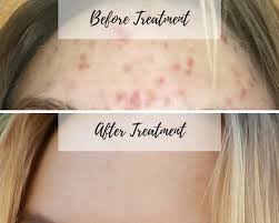 Pin On Dermatillomania