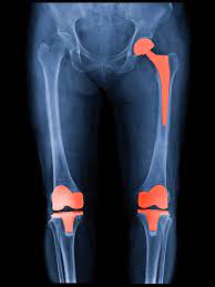 To elaborate on above answer bilateral knee replacement is a surgical procedure where in knee replacement surgeon replaces both arthritic knees of patients in a same hospitalization period. How Long Will My Hip Or Knee Replacement Last Harvard Health