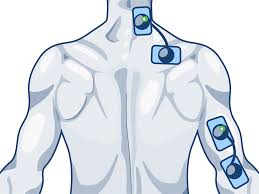 Anatomie, physiopathologie, traitement médical et chirurgical ou microchirurgie. Programme Et Electrostimulateurs Pour Nevralgies Brachiales Electrostimulateur Ch