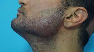 What do to about it: Hair Transplantation In Scarring Beard Face Cause By Acne Ak Clinics