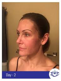 I am so happy i found this wonderful spa!! Before And After Gallery Pacific Coast Aesthetics In Aptos Ca