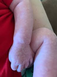Mottled skin is also called livedo reticularis and it thought to be connected to vascular. Mottled Skin Pic March 2020 Babies Forums What To Expect