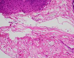 Esophagitis, also spelled oesophagitis, is a disease characterized by inflammation of the esophagus. February 3 2020 Week 2 School Of Medicine Pathology Uab