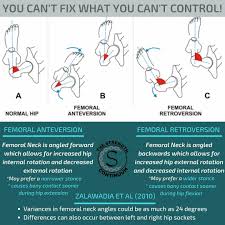 Image result for Femoral Retroversion