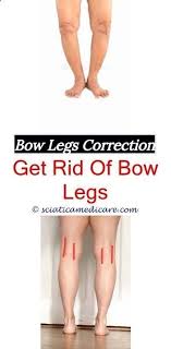 Permanent Remedy For Bow Legs Bow Legs Correction What Causes Bow Legs Bow Legged Arthritis Bowedleg Com Bow Bow Legged Correction Bow Legged Knock Knees