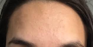 Acne What Are These Skin Colored Whitish Bumps On My Forehead Are These Comedones Or White Heads How Do I Mak Healthy Skin Cream Diy Skin Cream Whiter Skin