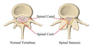 As part of the central nervous system, the spinal cord (medulla spinalis) is held in place by ligaments and is well protected in the spinal canal of the vertebral column. Chiropractic Care For Spinal Stenosis Pain Mission Valley San Diego
