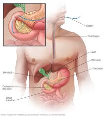 Gallstone symptoms may be similar to symptoms of other. Gallstones Diagnosis And Treatment Mayo Clinic