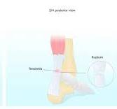 Achilles Tendinitis in Children - Causes and Treatment