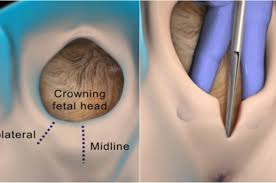 Tanda jahitan mungkin masih kelihatan atau tidak. Berapa Lama Episotomi Saya Mengambil Masa Untuk Sembuh Dr R Juhaidah Blog