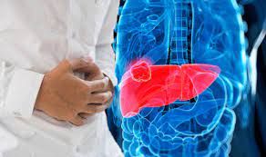 You should know if the goal of treatment is treatment choices for advanced cancer depend on the type of cancer, where the cancer started, and how much it has spread into the area around it. Bowel Cancer Symptoms And Signs That It Has Spread To The Liver Spotted These Express Co Uk