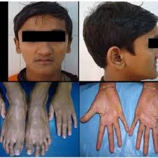 Panoramic radiograph showing “Floating in air” appearance of teeth.