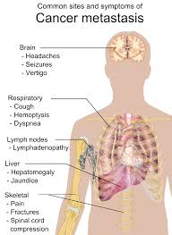 Pin On Cancer Metastasis