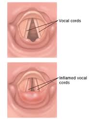 Image result for Vocal Cord Dysfunction