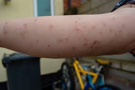 Image result for bedbugs bites