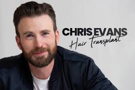 Chris Evans Hair Transplant
