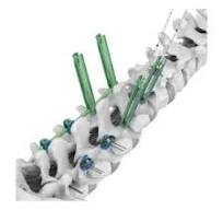 MoP Apollo Cementless Acetabular Cup System,Medical Device ...