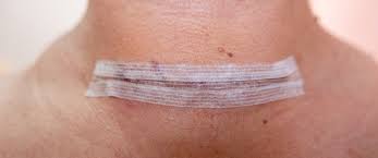 نصائح ما بعد عملية الغدة الدرقية ويب طب