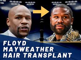 Floyd Mayweather Hair Transplant