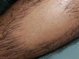 According to the american society of plastic. Lasers In Dermatology Dermnet Nz