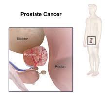 Many men with prostate cancer die of other causes without ever knowing that they had the cancer. Prostate Cancer Wikipedia