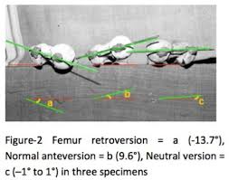 Image result for Femoral Retroversion
