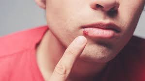ما هى اعراض مرض الايدز ومتى تظهر وما هي طرق علاجه مختلفون