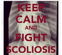 Pin On Scoliosis