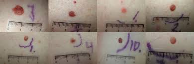 Cancerous growth of melanocytes results in melanoma. Melanoma Genetics Journal Of Medical Genetics