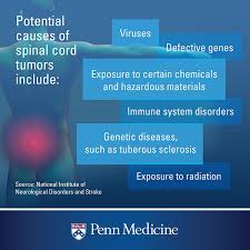 Cancer that spreads to the brain can compress the brain and cause swelling inside the skull, leading to headaches. When You Could Have A Spinal Tumor And Why It S So Hard To Diagnose Penn Medicine