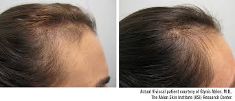 After several viviscal reviews, viviscal extra strength hair loss supplements and hair loss vitamins is one of the best ways to promote healthy, stronger hair and skin. Viviscal Professionals Hairloss Products
