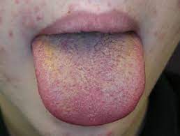 Black tongue is a condition in which the tongue has a black appearance. Hairy Tongue Dermnet Nz