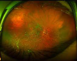 Pin By Anju Nagar On Focus On Eye Health Eye Health Diseases Of The Eye Ocular