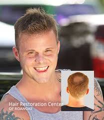 It can be the result of heredity, hormonal changes, medical conditions or a normal part of. Non Surgical Hair Replacement Hair Restoration Roanoke Virginia