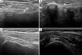 I've treated two patients in the last few months whose lung cancer presented with shoulder pain. Representative Image Of Shoulder Ultrasonography In Patients With Download Scientific Diagram