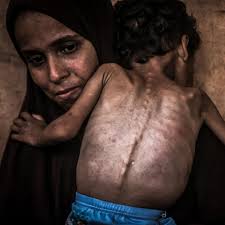 2-year-old Palestinian Yezen Abu Ful, whose health has deteriorated due to  lack of access to food and nutritional supplements, is seen with his mother  in the Al-Shati Refugee Camp in Gaza Strip
