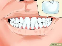 Check spelling or type a new query. How To Avoid Dental Crown Problems 13 Steps With Pictures