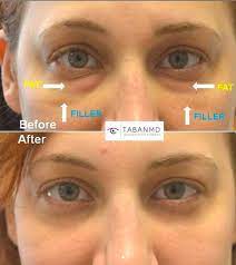 Lower Blepharoplasty After Hyaluronidase Injection After Previous Filler Eye Bag Surgery Under Eye Fillers Injectables Fillers