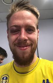 €5.00m* feb 13, 1991 in.facts and data. Leeds Star Pontus Jansson Reveals Gruesome Eye Injury From Preston Win Daily Mail Online