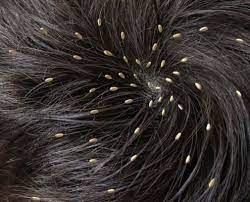 Head lice (pediculus humanus capitis): Does Hair Dye Kill Lice Alternative Methods To Kill Lice Hair Theme