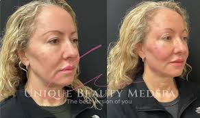 Lip Fillers Near Valrico