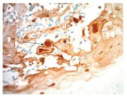 Herpes esophagitis is caused by hsv type 1. Atypical Manifestation Of Herpes Esophagitis In An Immunocompetent Patient Case Report And Literature Review