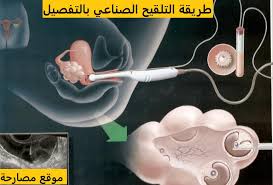 تجربتي مع نجاح التلقيح الصناعي في البداية يعرف التلقيح الصناعي هو الإدخال المتعمد للحيوان المنوي إلى رحم أو عنق رحم للإناث من أجل تحقيق الحمل عن طريق الإخصاب الحي بواسطة وسائل أخرى غير. Ø§Ù„Ø¹Ø¨Ù‚Ø±ÙŠ Ø¹Ù†Ø§Ù‚ Ø®Ø±Ø¯Ù„ Ø·Ø±ÙŠÙ‚Ø© Ø§Ù„ØªÙ„Ù‚ÙŠØ­ Ø§Ù„ØµÙ†Ø§Ø¹ÙŠ Ø§Ù„Ù…Ù†Ø²Ù„ÙŠ Tutihomestays Com
